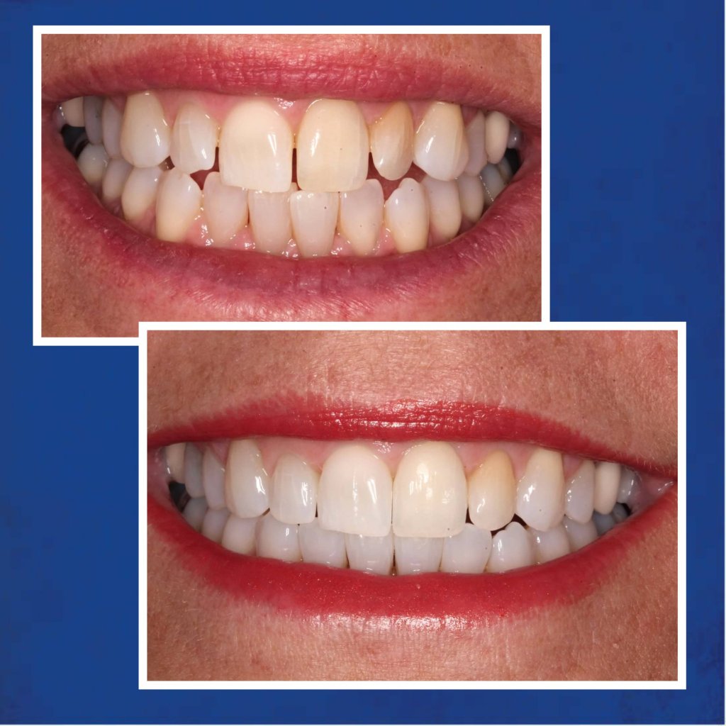 Before & After Invisalign