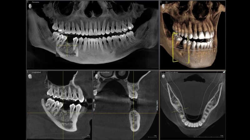 3d-imaging of a jaw