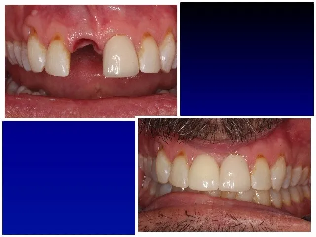 Before & after implant crown