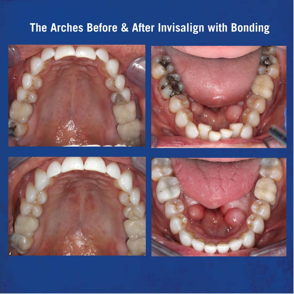 Before & After Invisalign with Bonding