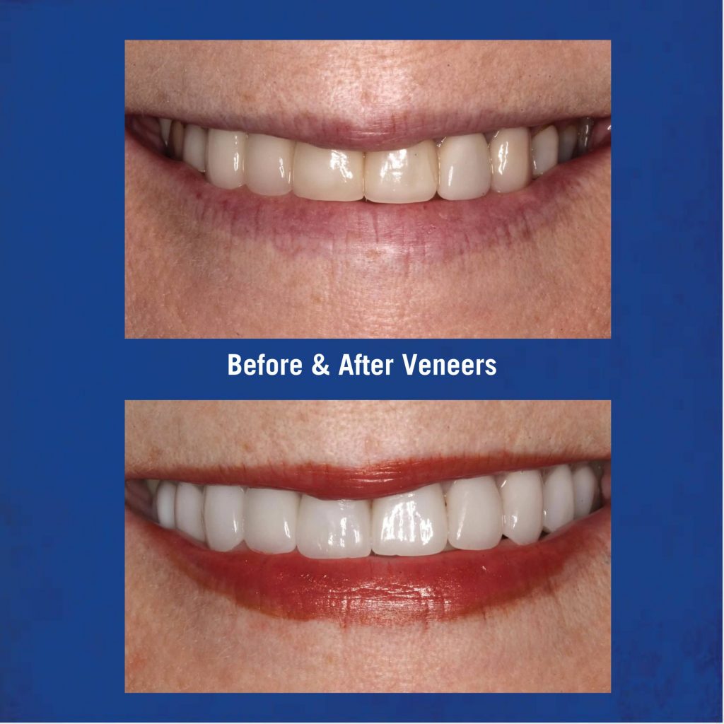 Before & After Veneers