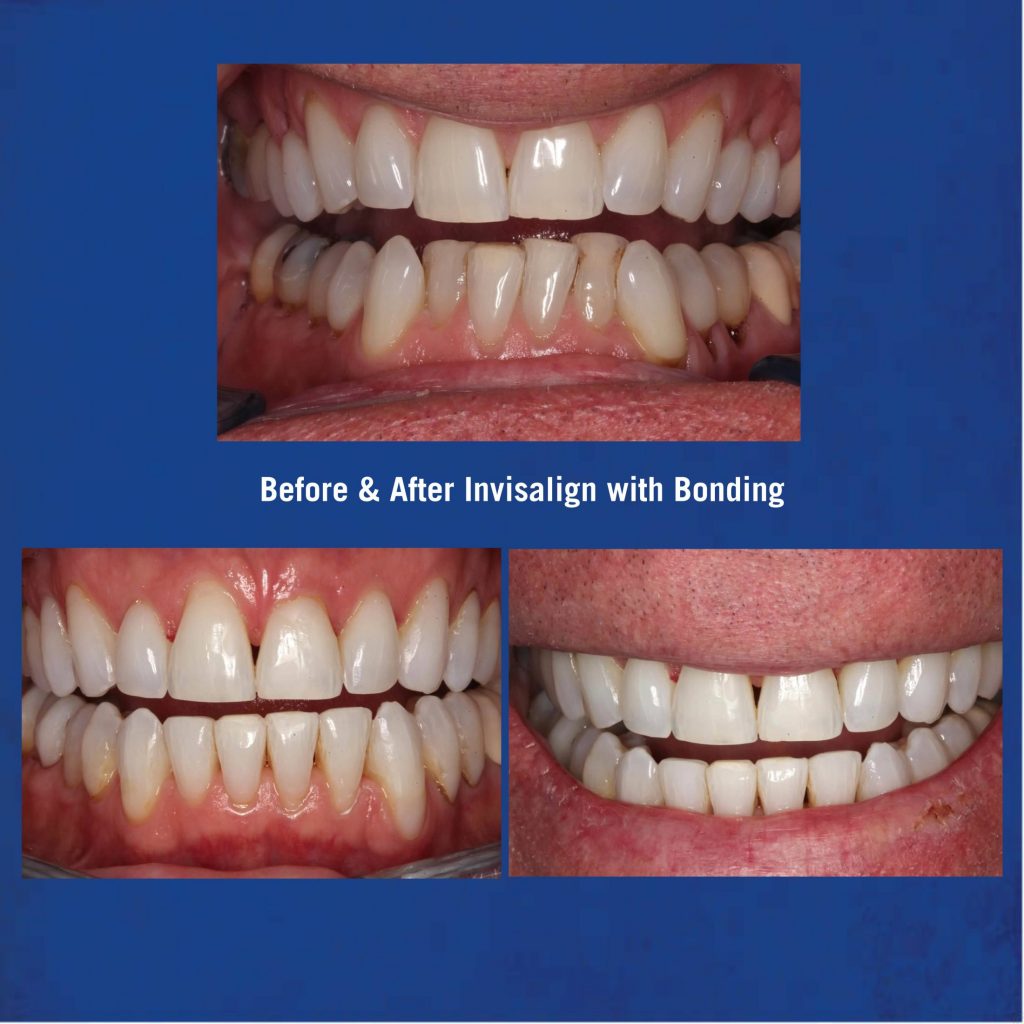 Before & After Invisalign with Bonding