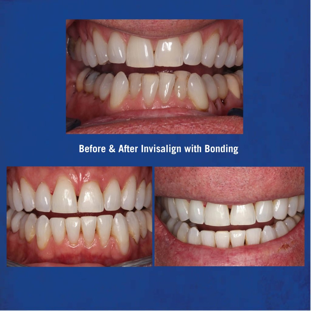 Before & After Invisalign with Bonding