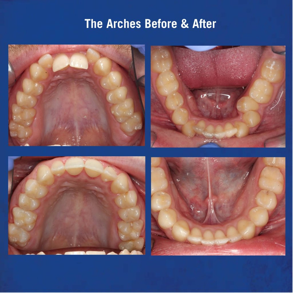 Before & After Braces