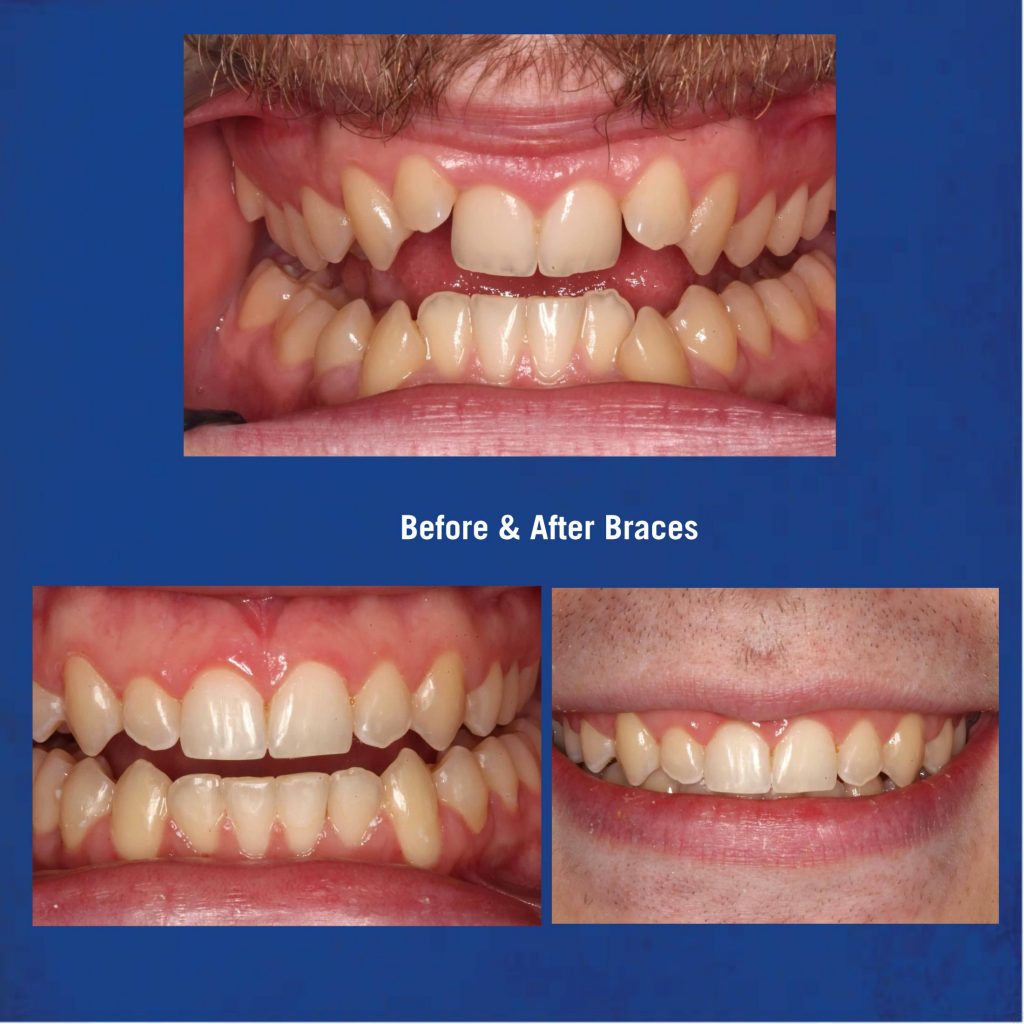 Before & After Braces