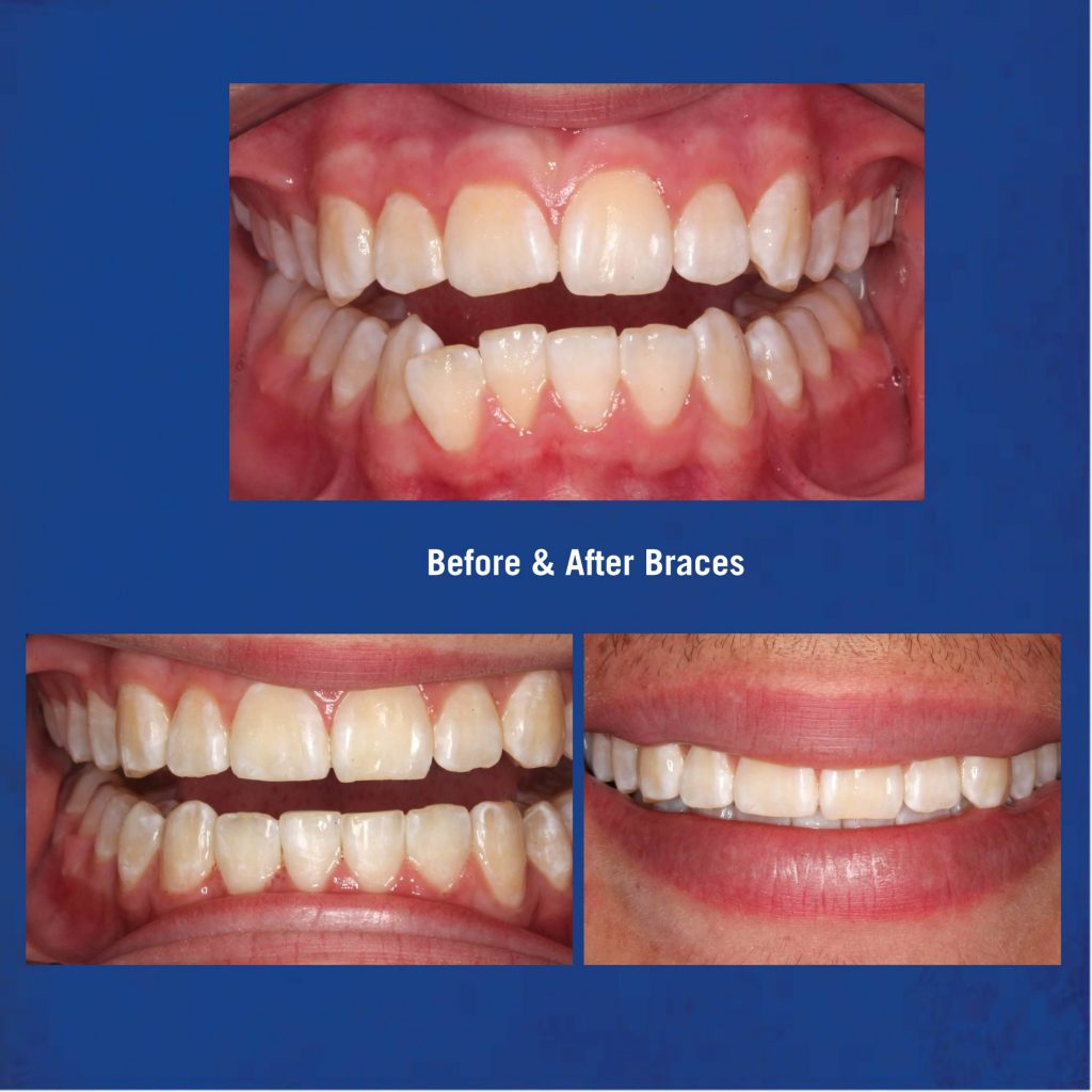 Before & After Braces