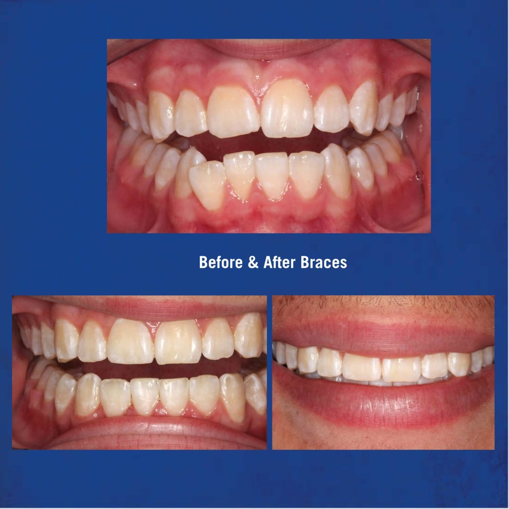 Before & After Braces