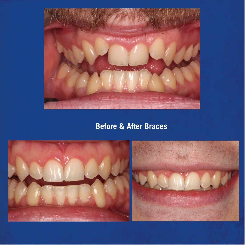 Before & After Braces