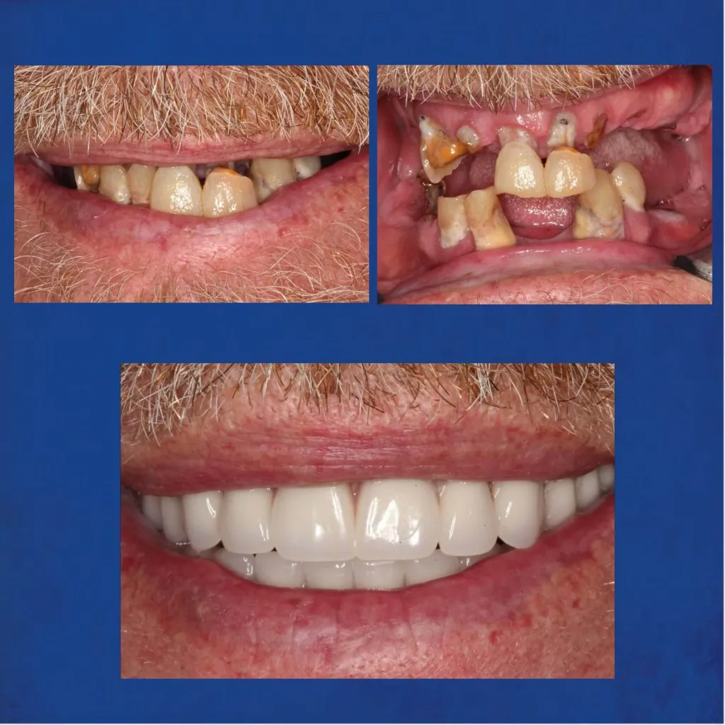 Before & After Dentures