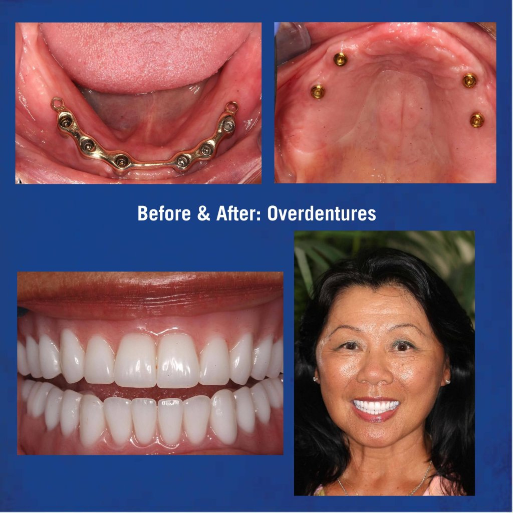 BEFORE & AFTER: IMPLANT SUPPORTED LOCATOR OVER DENTURE (TOP & BOTTOM)