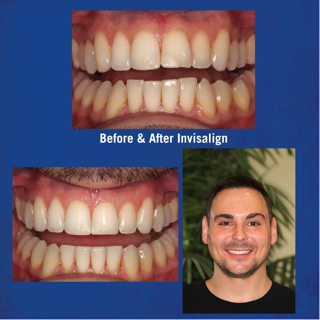 Before & After Invisalign