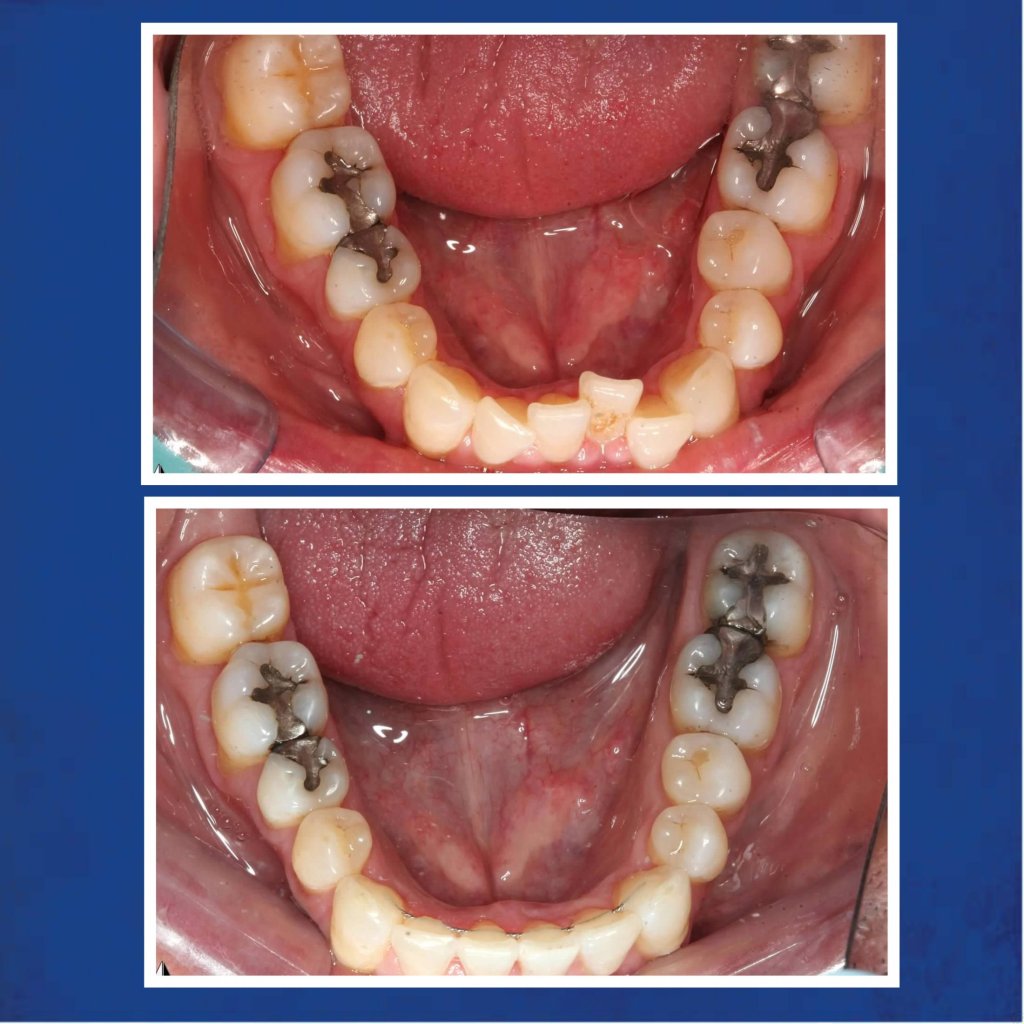 Before & After SureSmile Treatment Case #2