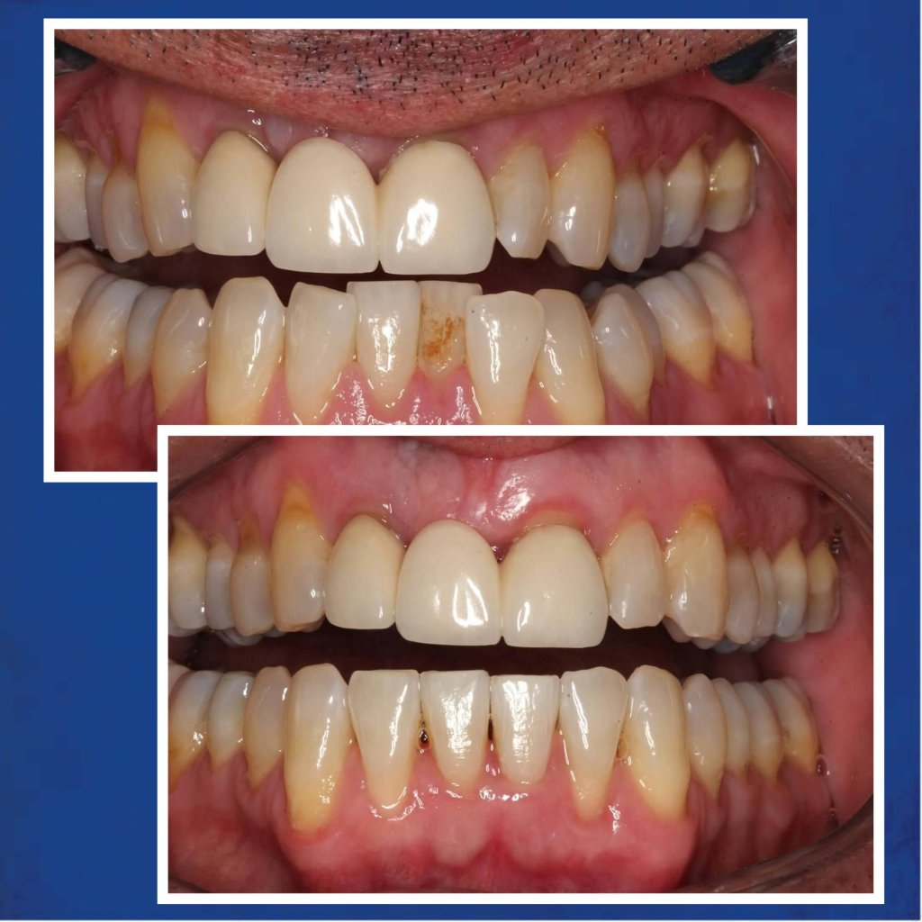 Before & After SureSmile Treatment Case #1 