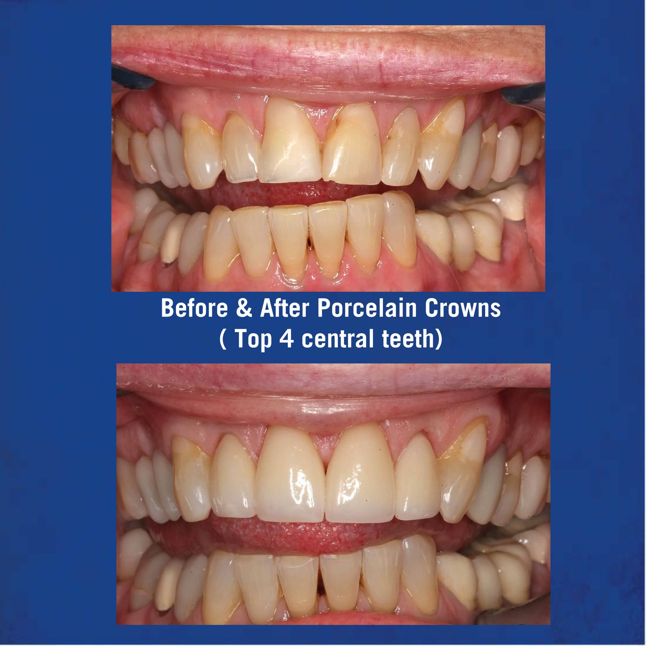 Before & After Porcelain Veneers - Top 4 Central Teeth