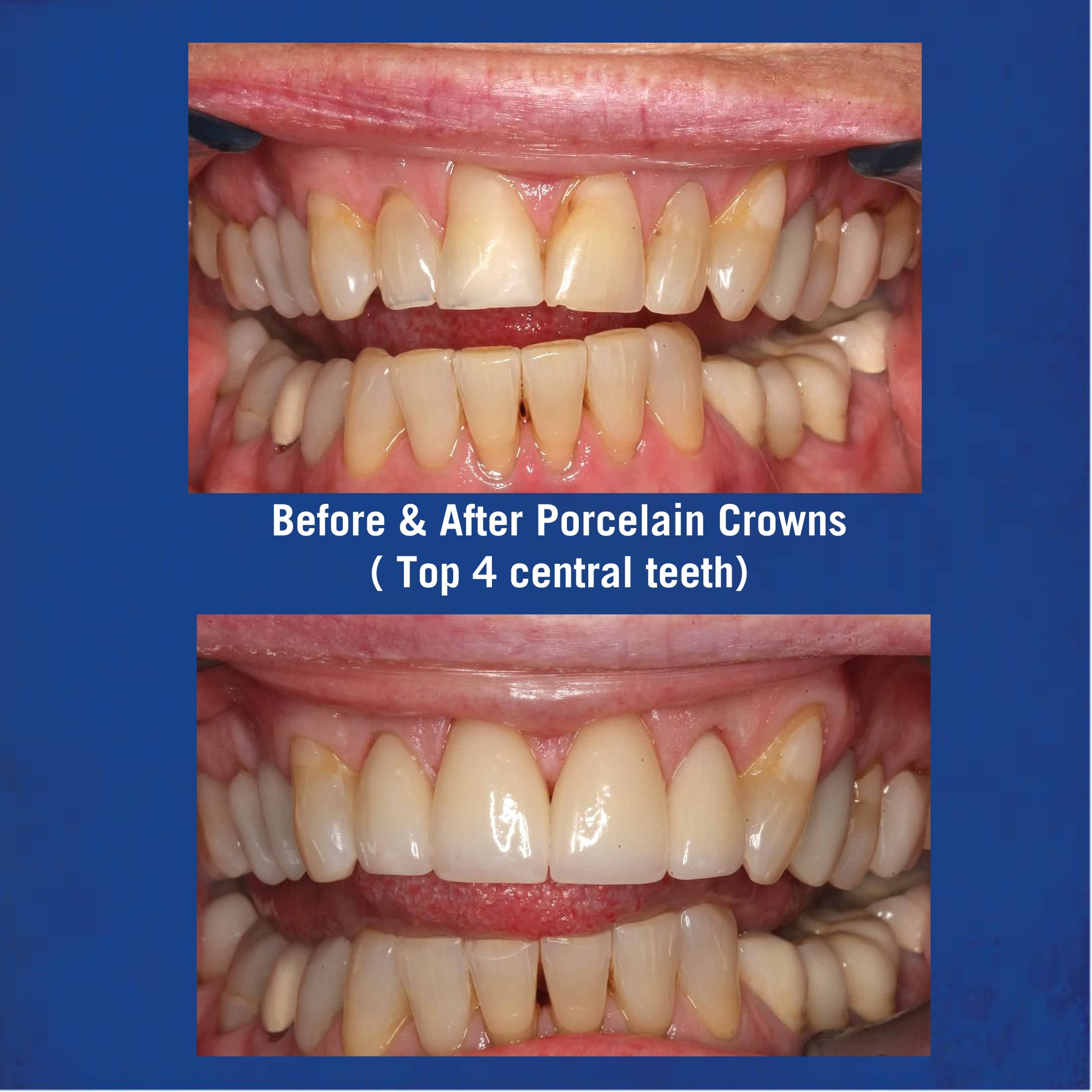Before & After Porcelain Veneers - Top 4 Central Teeth