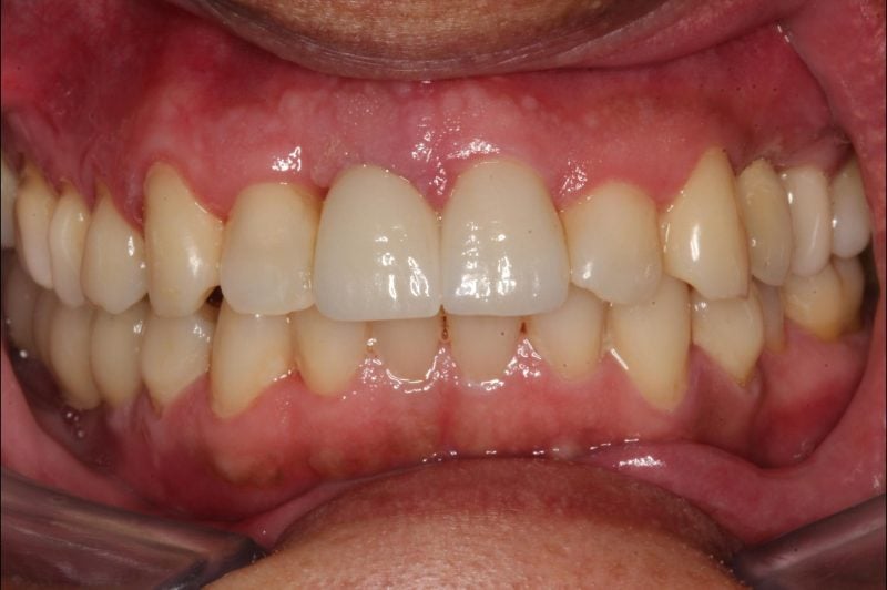 porcelain crowns, bridges & implants : After