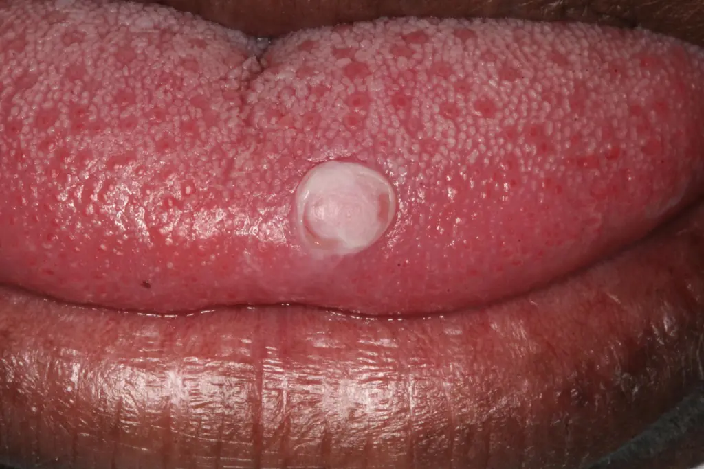 antes de la eliminación del fibroma