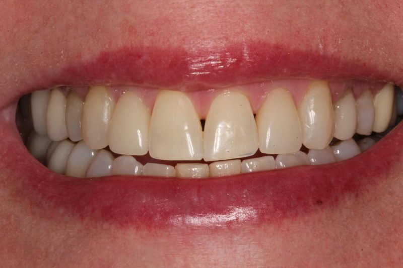 After suresmile aligners, crowns & veneers