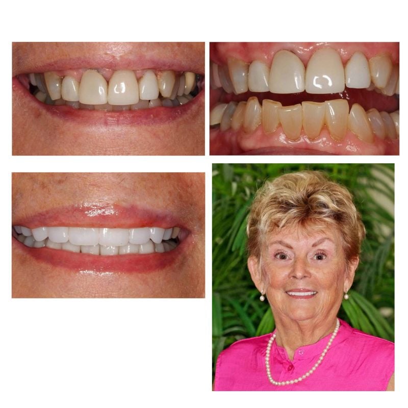 Before and after images of a dental patient showing improved teeth