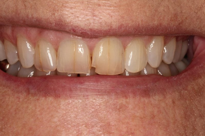 another beautiful transformation: anterior crowns - Before