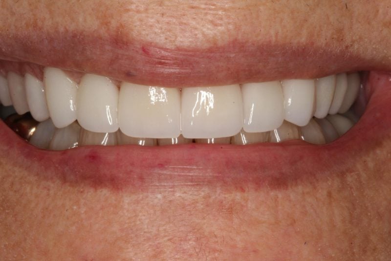 another beautiful transformation: anterior crowns: after