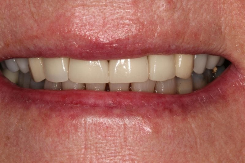 Before anterior crowns