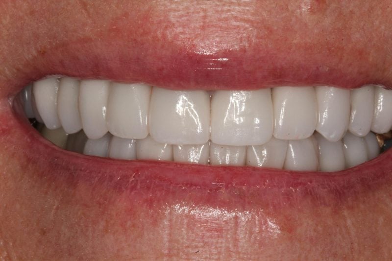 After anterior crowns