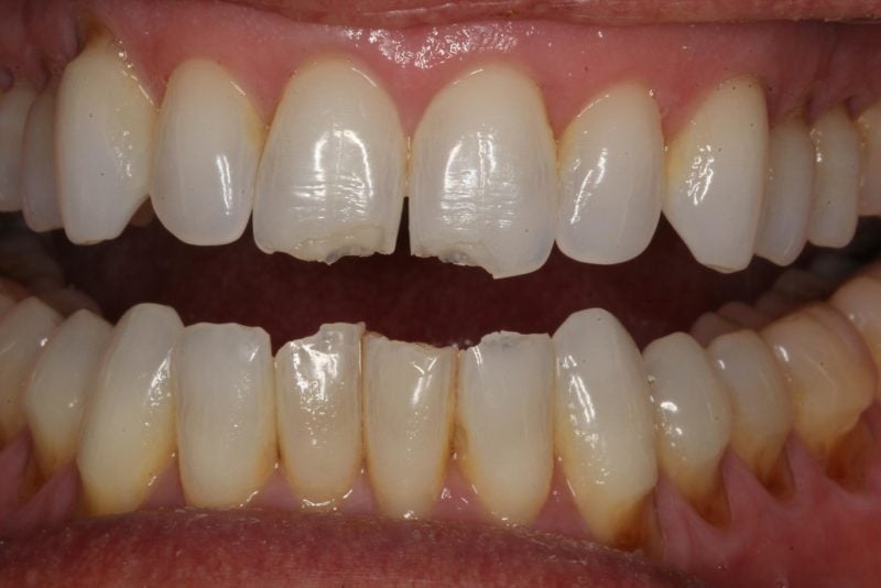 before procedure for teeth that are chipped, cracked, discolored or crooked.