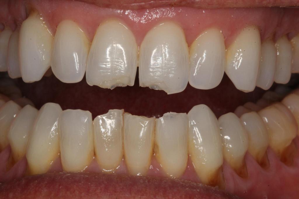 Tooth Bonding Wellington FL, Chipped & Discolored Tooth, Stained Teeth