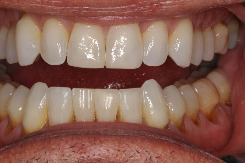 after procedure for teeth that are chipped, cracked, discolored or crooked.