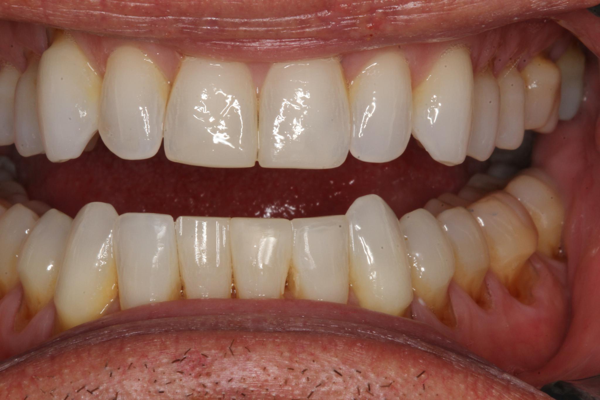 Tooth Bonding Wellington FL, Chipped & Discolored Tooth, Stained Teeth