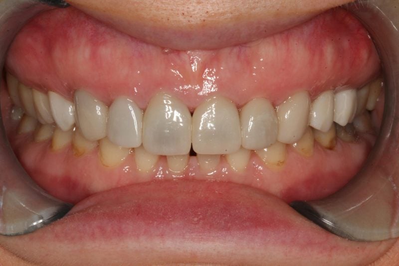 Before anterior crowns