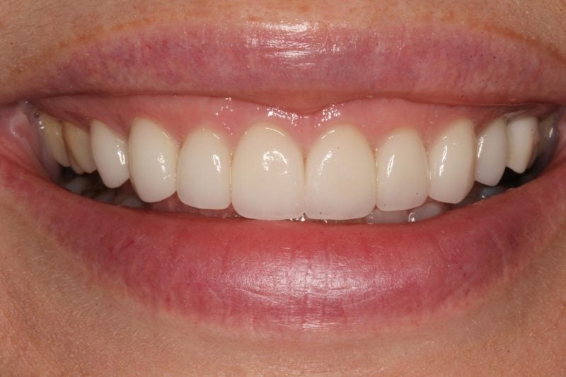 After anterior crowns