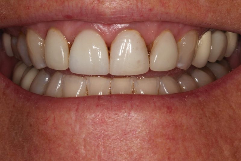 Close-up image of a mouth before dental crown
