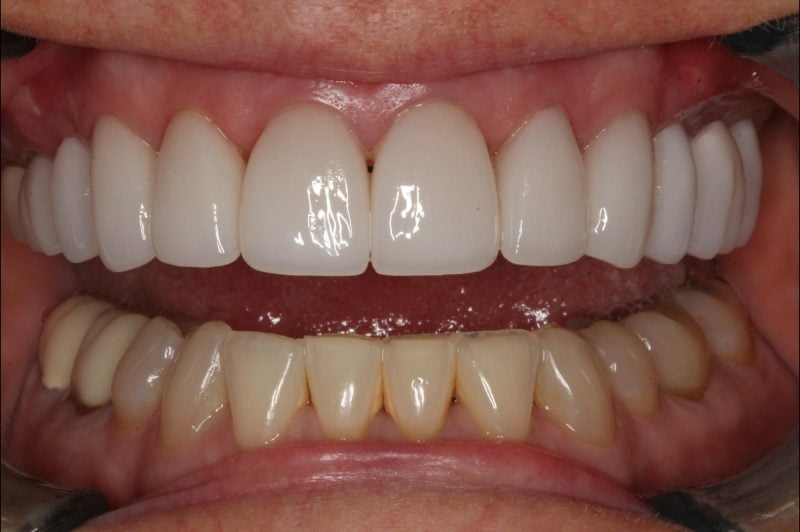 Close-up image of a mouth after dental crown