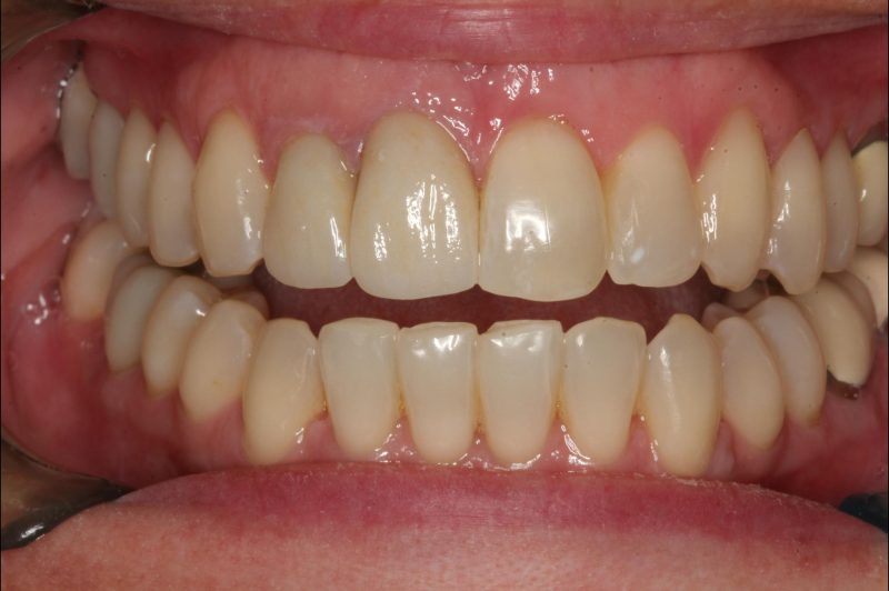 Close-up image of a mouth after dental crown