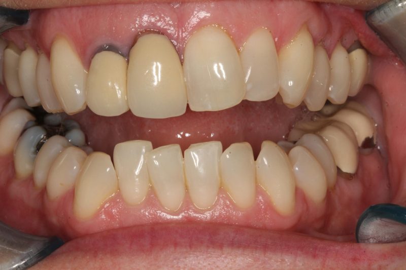 Close-up image of a mouth before dental crown