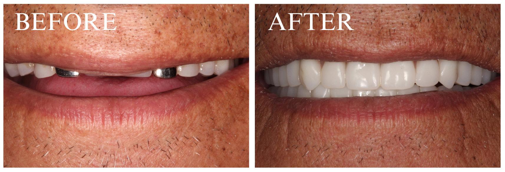 Denture Case 1