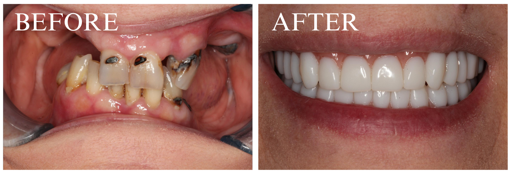 Locator Overdenture Case 1