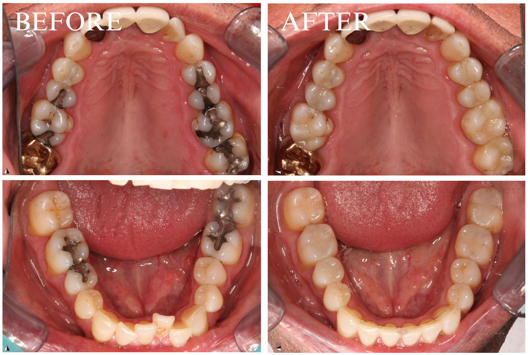 Filling Case 2