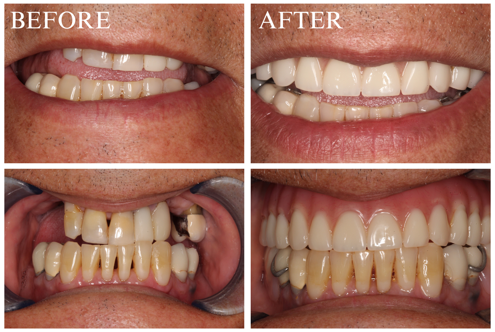 Hybrid Overdenture Case 1 v2