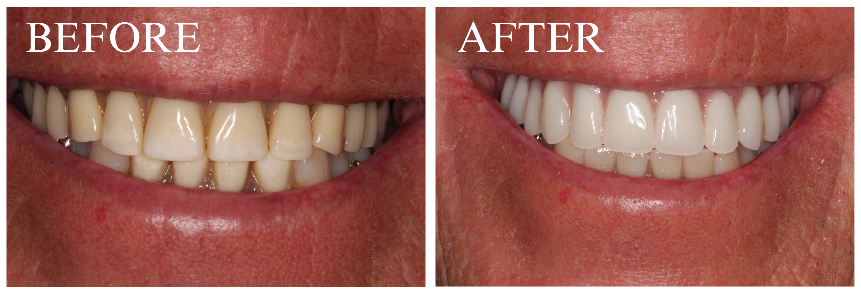 Hybrid Overdenture Case 4