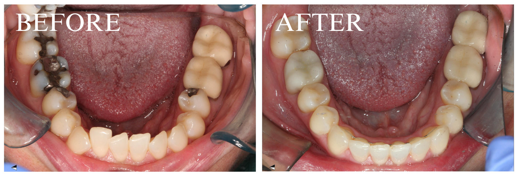 Crown Case 4
