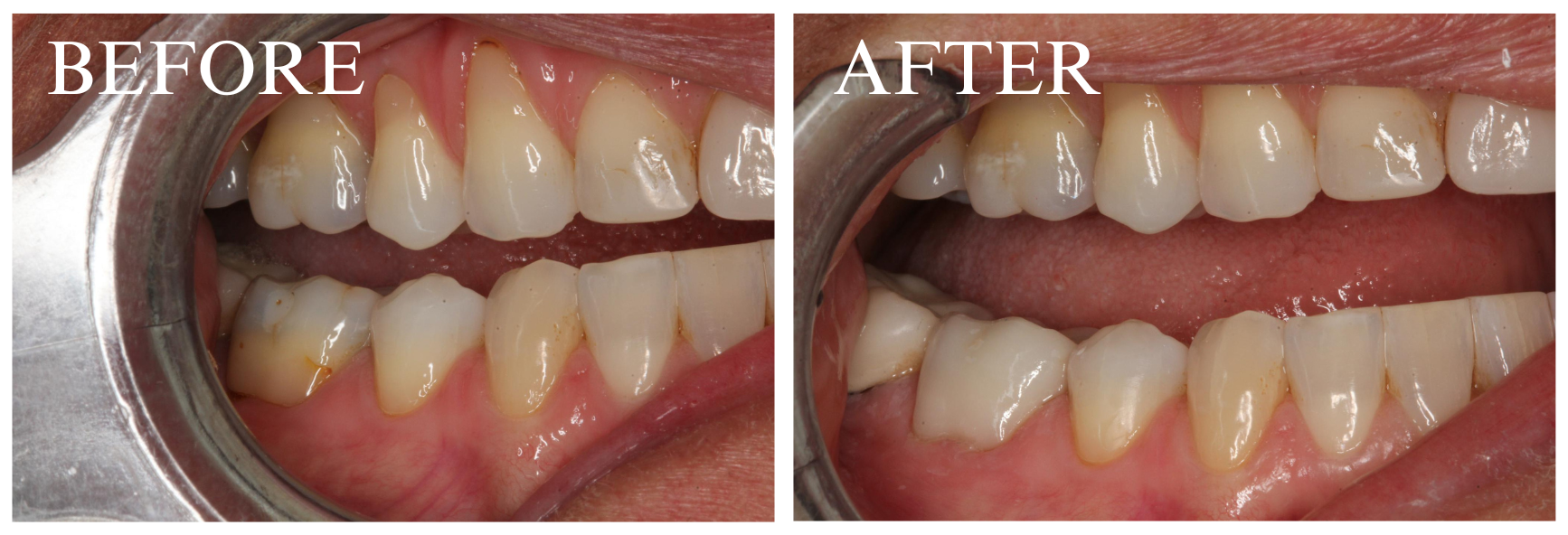 Crown Case 8.1