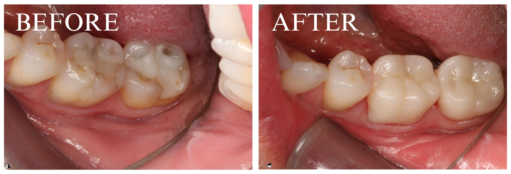 Crown Case 8.2