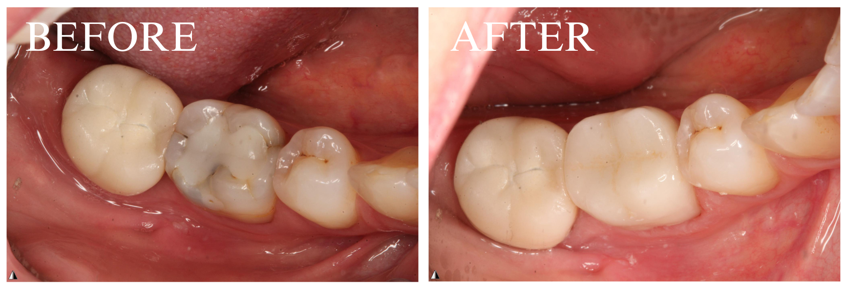Crown Case 8.3