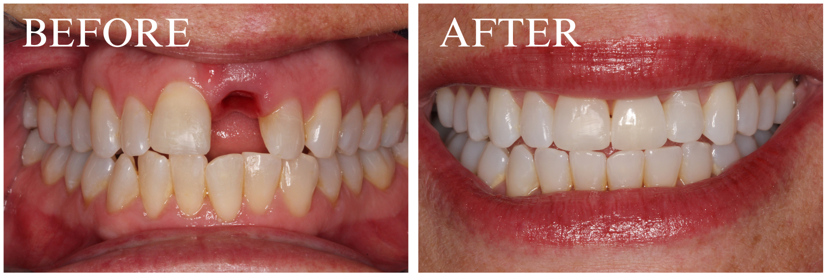 Implant Case 1