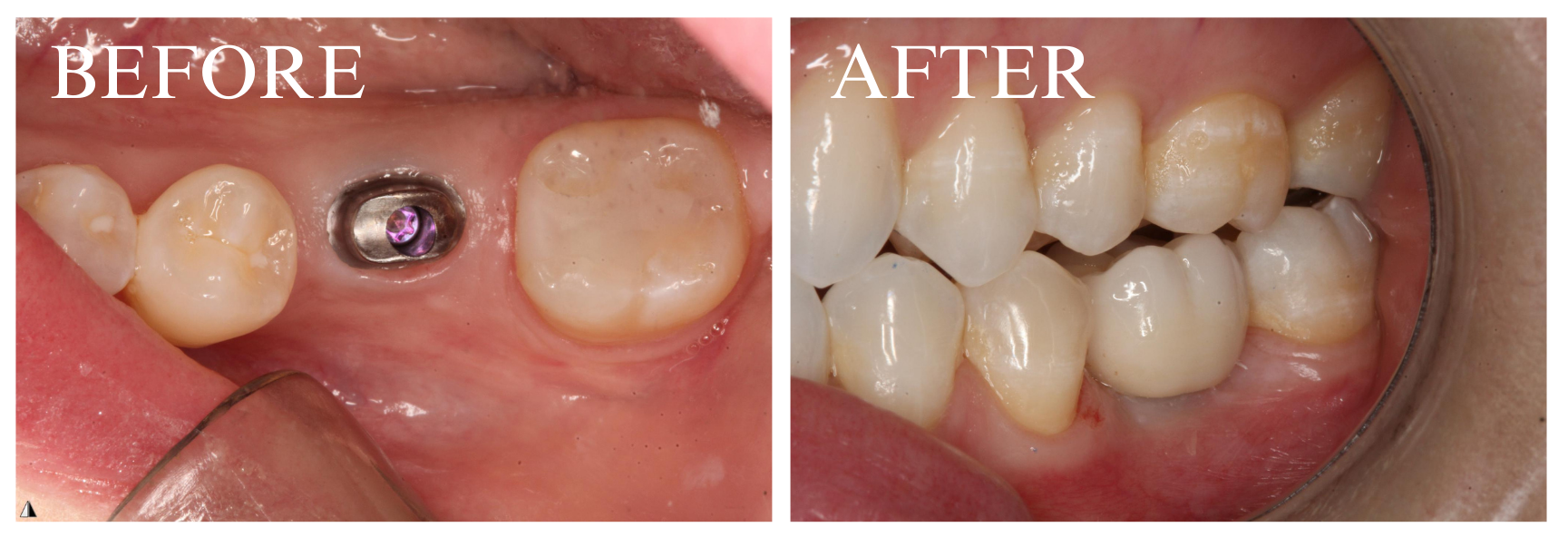 Implant Case 2
