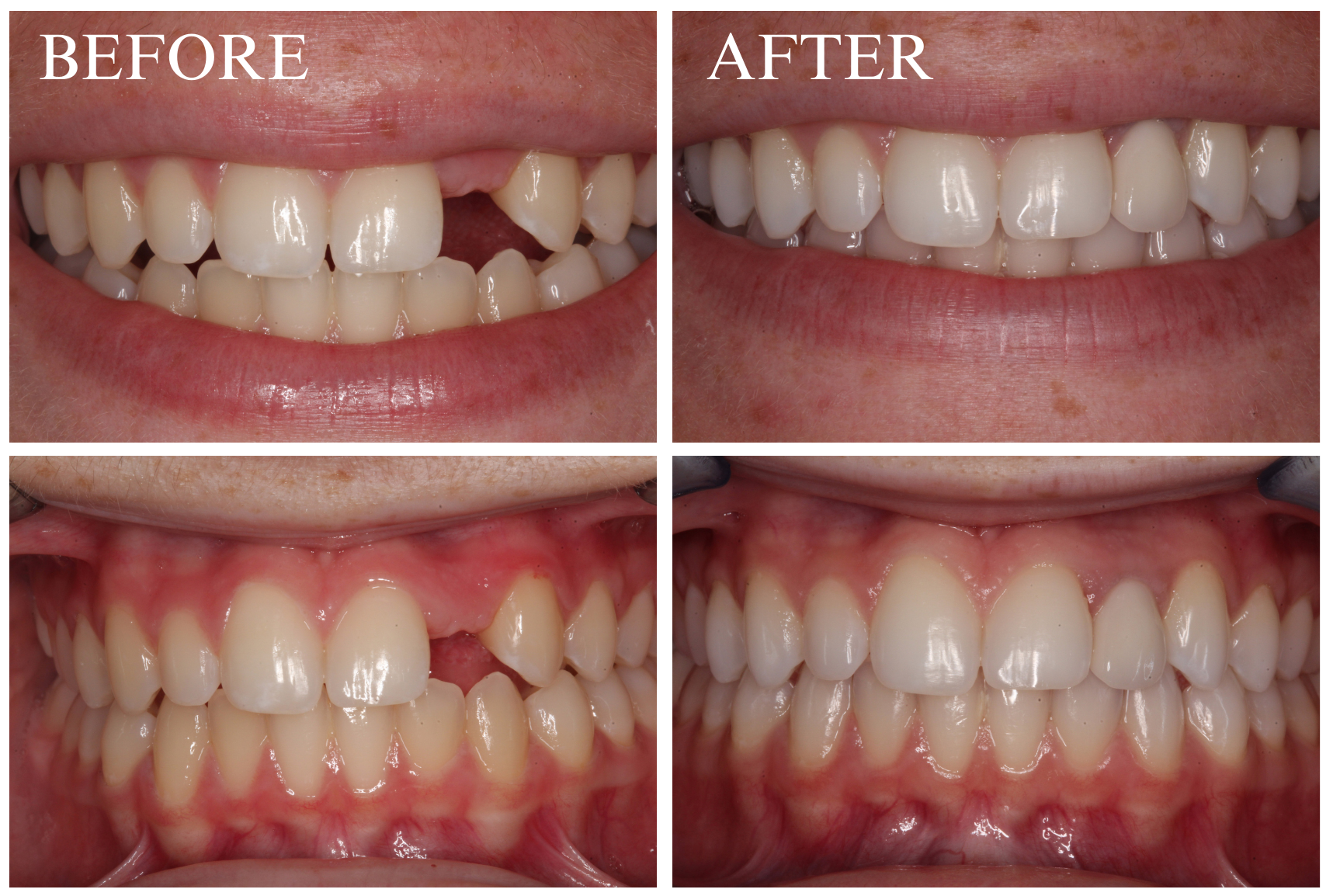 Implant Case 4