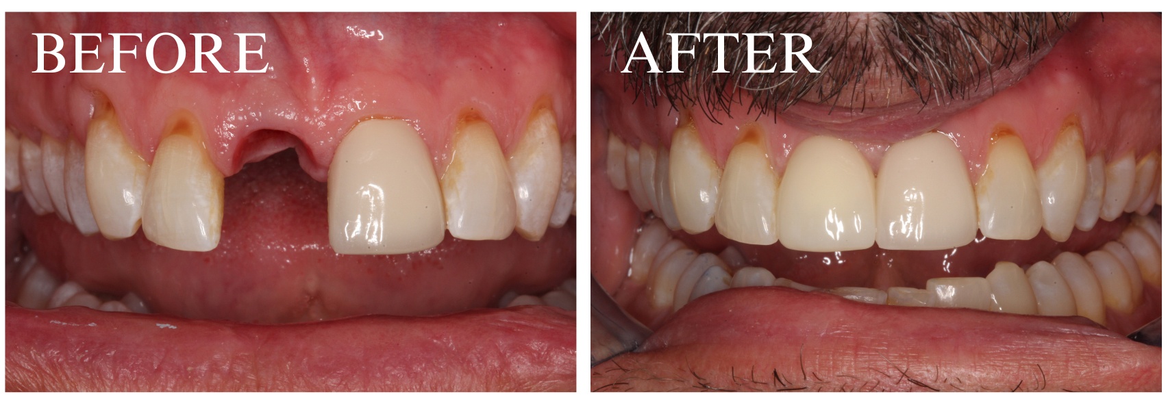Implant Case 5